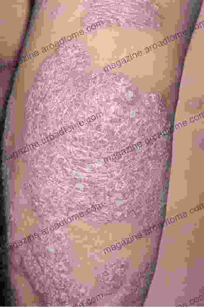 A Person With Psoriasis On Their Arm Psoriasis: Targeted Biologic Treatments 2024 (Medicine 2024 5)